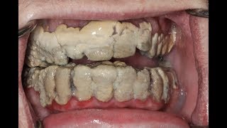 20 Years Without Brushing Teeth 😦 | Calculus Removal