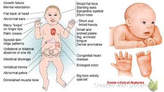 Common features of down syndrome