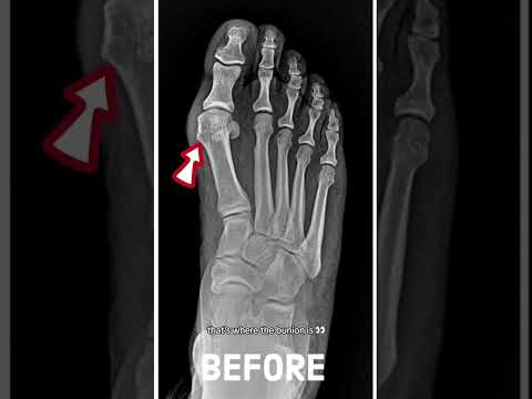 AMI Bunion Transformation: Your Feet Will Thank You