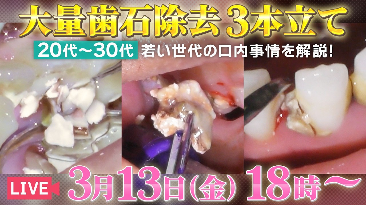 大量歯石除去3本立て🦷若い世代の口内事情を解説‼️
