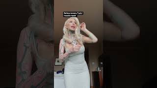 Before and 8 weeks after tummy tuck