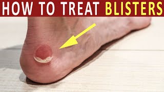 How to Treat Blisters |  Home remedies of blister treatment and heal