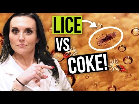 Removing Head Lice with Coca Cola (Coke) - Watch this BEFORE you try!