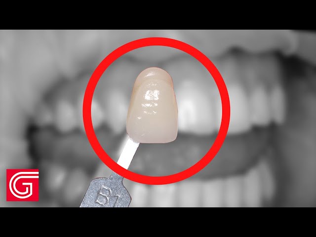 Vídeo relacionado con Muestrario profesional en 3D con 22 tonos para comparar el tono de los dientes, guía de tonos para clínicas y centros de estética