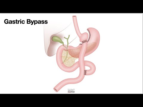 HCC 1475 10n  Surgical Anatomy Gastric Bypass
