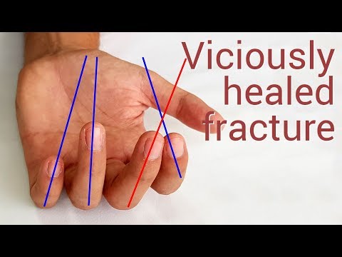 Articulația mare a degetului doare bump