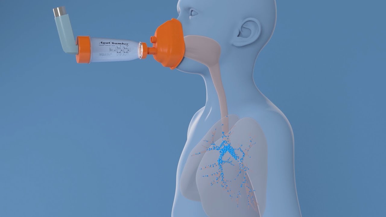 Watch Now Por que administrar spray inalatório (bombinha) utilizando espaçador para inalação Por que administrar spray inalatório (bombinha) utilizando espaçador para inalação