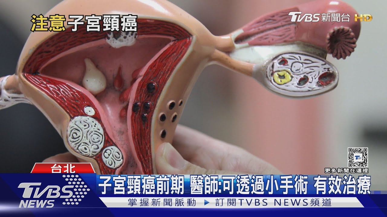 女性注意輕忽「這兩件事」 醫師:罹子宮頸癌風險高!