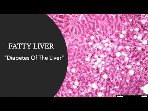 Fatty Liver: A "Drug-able" Or "Lifestyle-able" Problem?