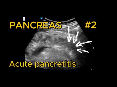 Acute necrotizing pancreatitis  video preview