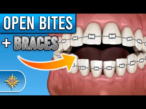 How Do Braces Fix Open Bites? | Premier Orthodontics