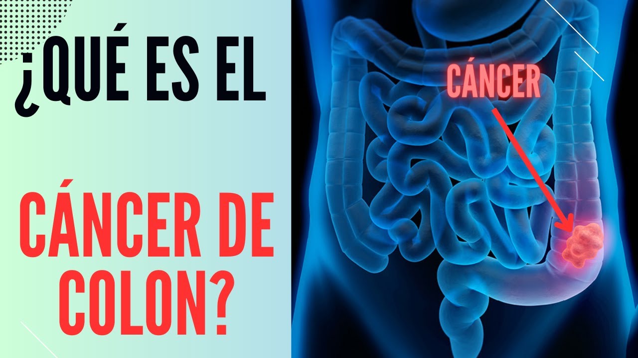 What is colon cancer?
