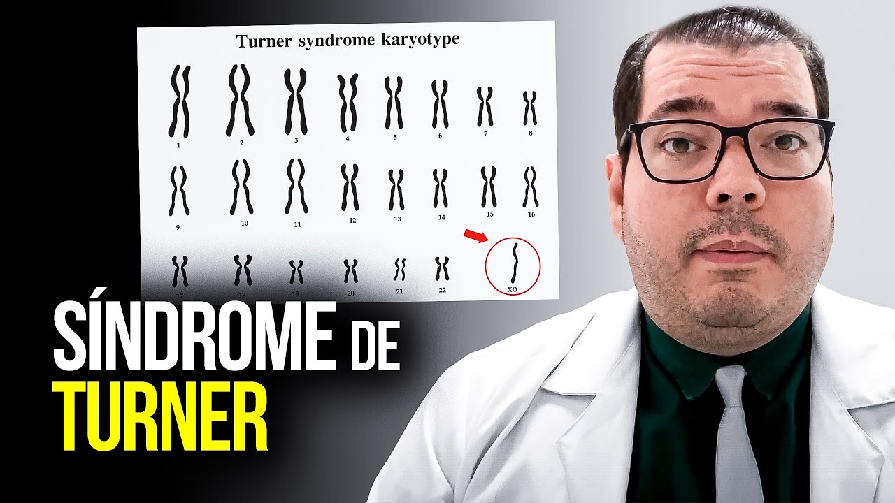 Síndrome de Turner - O Que é Síndrome de Turner (45 X)