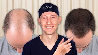 How To Reverse YOUR Hair Loss