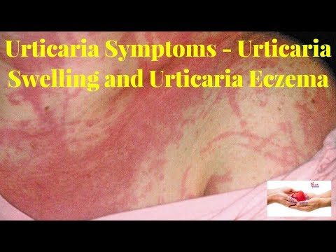 Differenze di dermatite atopic e dermatite perioralny Uso di olio di coronopo del mare a eczema