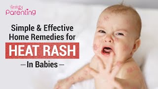8 Simple Home Remedies for Heat Rash On Babies