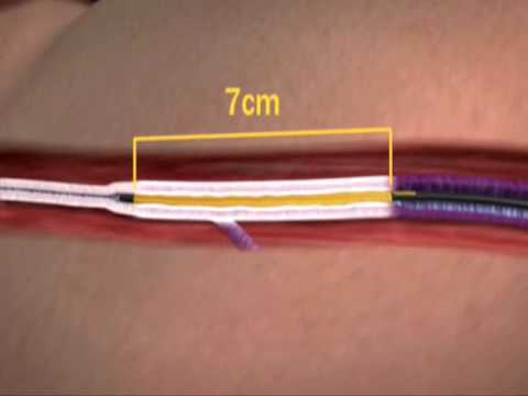 The VNUS Closure Procedure Using ClosureFAST Catheter