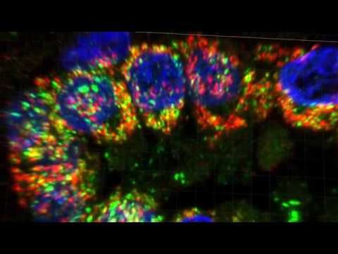 21 Month-Old Human Lung 17235 Containing Homozygous Missence ABCA3 Mutation 21 Month-Old Human Lung 17235 Containing Homozygous Missence ABCA3 Mutation