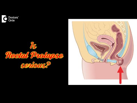 5 Symptoms to recognize Rectal Prolapse: Causes, Treatment - Dr. Rajasekhar M R | Doctors' Circle