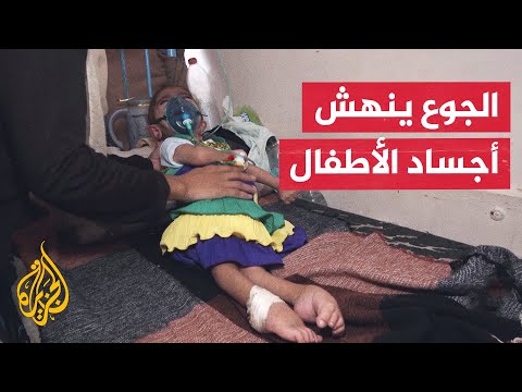 فيديو | تفاقم حالات سوء التغذية بين أطفال غزة