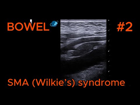 Superior Mesenteric Artery (SMA) Syndrome video preview