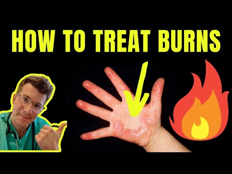 HOW TO TREAT AND MANAGE BURNS AND SCALDS | DOCTOR EXPLAINS (plus first aid tips)