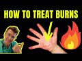 HOW TO TREAT AND MANAGE BURNS AND SCALDS | DOCTOR EXPLAINS (plus first aid tips)
