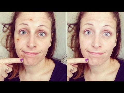 Trattamento della malattia degenerativa del disco cervicale esercizi di yoga Metodo di trattamento delle articolazioni