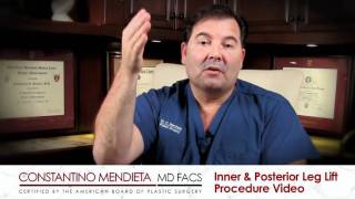 Inner and Posterior Leg Lift -- Miami Plastic Surgeon