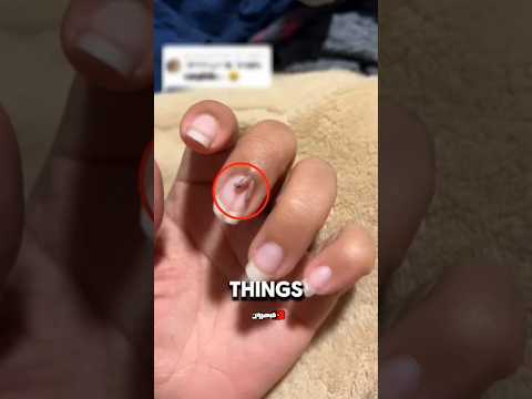 أوساخ الأظافر 💅 تحت المجهر 😱