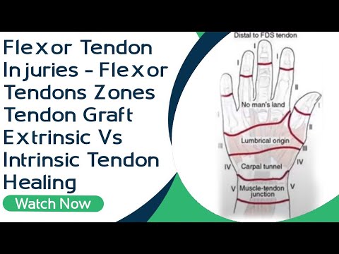 Flexor Tendon Injuries