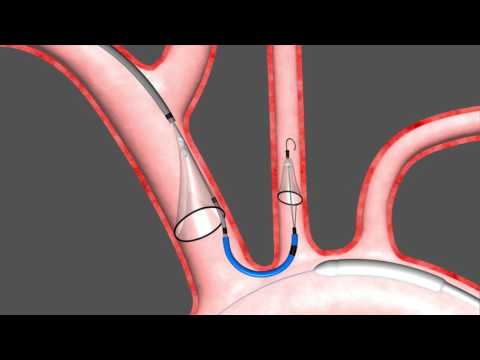 Animation of Sentinel™ Cerebral Protection System