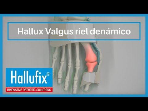 Hallufix®  Hallux valgus riel dinámico
