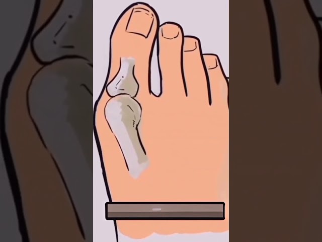 دعامة قدم مع الابهام المطور فري سايز HTF 1001A