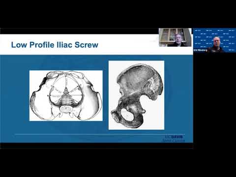 Options for Iliac Screw Trajectory with Eric Klineberg, MD - West Coast Fellows Conference