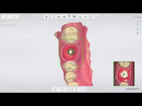 How to Scan an Implant Case - Trios Video