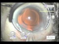 Achieving Excellence In Cataract Surgery