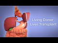 Medical Animation: Living Donor Liver Transplant | Cincinnati Children's