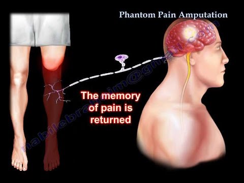Phantom Pain Amputation - Everything You Need To Know - Dr. Nabil Ebraheim