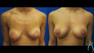 Areola Reduction in Connecticut