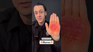 Burned your hand? Try this… #medical #health #cooking