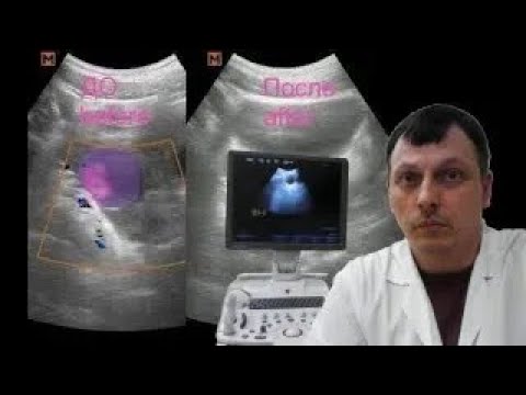 Pediatric Female pelvic ultrasound - Cysts in the pelvis
