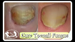 Pedicure: How to Cure Toenail Fungus