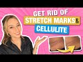 How to Get Rid of Stretch Marks & Cellulite from a Dermatologist! | Dr. Shereene Idriss