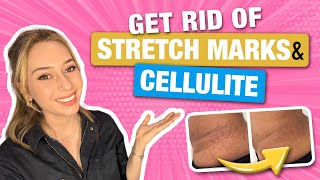 How to Get Rid of Stretch Marks & Cellulite from a Dermatologist! | Dr. Shereene Idriss