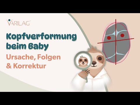 Kopfverformung beim Baby: Alles Wichtige zu Ursache, Folgen und Korrektur (Erklärvideo)