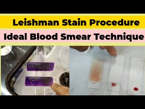 Leishman Stain Procedure and Blood Smear Preparation for DLC Count