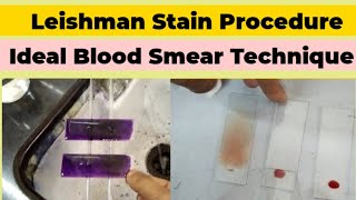 Leishman Stain Procedure and Blood Smear Preparation for DLC Count