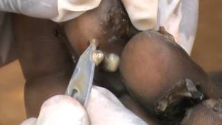 Young Dennis' Toes - Packed with Pregnant Jiggers