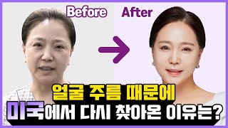 #안면거상 후 2개월 경과 되찾은 청춘*